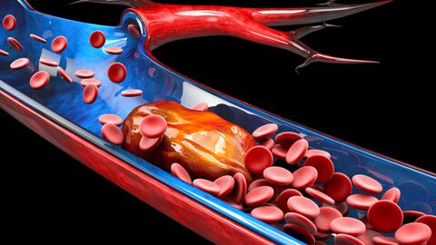 CME Angiologisches Update über venöse Thromboembolie